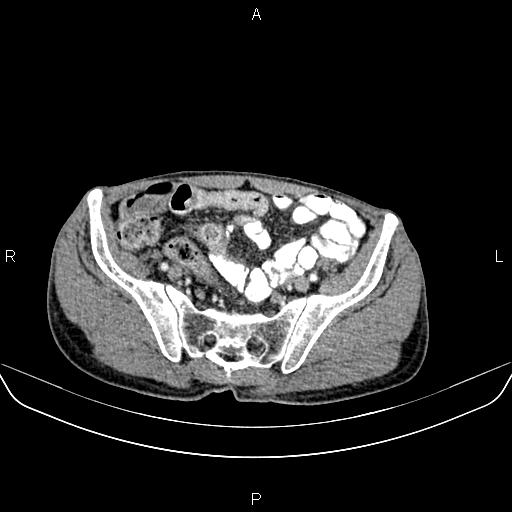Colon adenocarcinoma - hepatic flexure (Radiopaedia 85635-101395 A 75).jpg