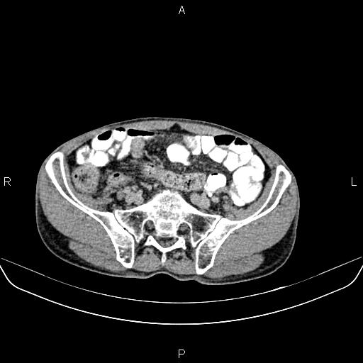 File:Colon adenocarcinoma - hepatic flexure (Radiopaedia 85635-101395 Axial C+ delayed 70).jpg