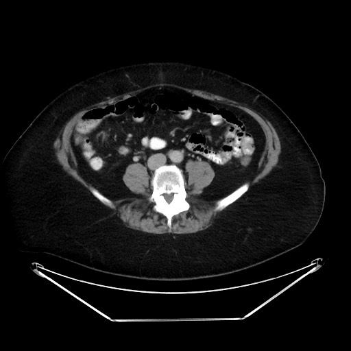 File:Colonic intussusception due to adenocarcinoma (Radiopaedia 86828-102987 A 94).jpg