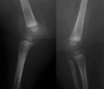 X-ray knees