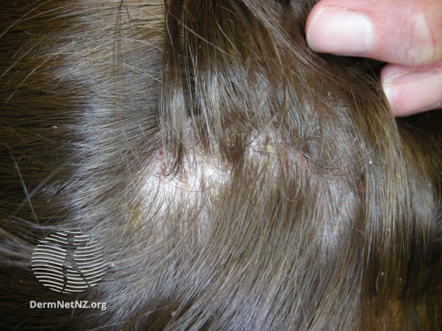 File:Head lice (DermNet NZ site-age-specific-head-lice-21).jpg