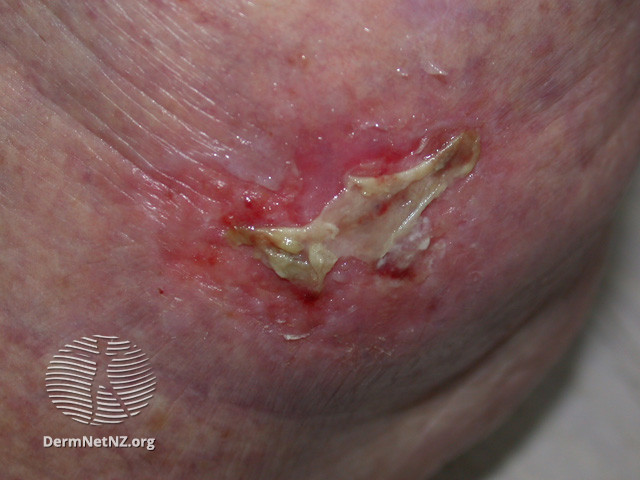 File:Intraepidermal carcinoma (DermNet NZ lesions-scc-in-situ-2937).jpg