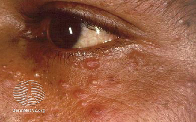 File:Multiple trichoepitheliomas (DermNet NZ lesions-tricho1).jpg