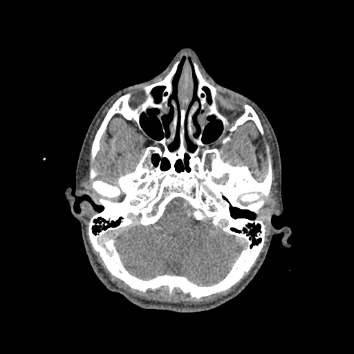 Nasal pyogenic granuloma (lobular capillary hemangioma) (Radiopaedia 85536-101244 C 83).jpg