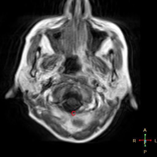 File:Nasopharyngeal carcinoma infiltrating the clivus (Radiopaedia 25229-25481 Axial T1 C+ 3).jpg