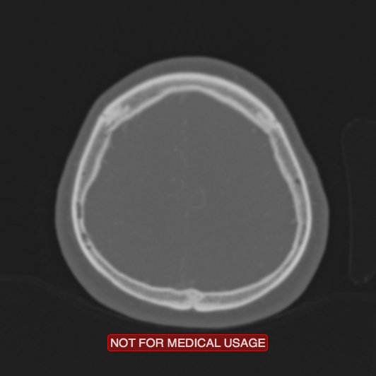 Nasopharyngeal carcinoma recurrence - skull base destruction (Radiopaedia 29107-29490 Axial bone window 22).jpg