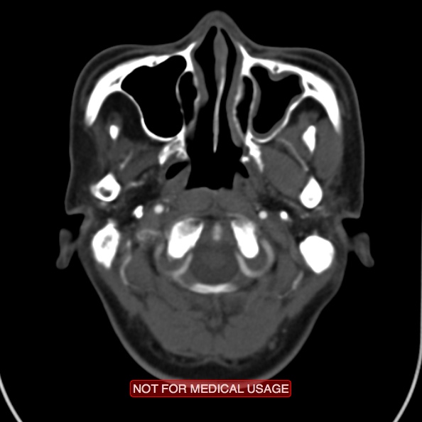 File:Nasopharyngeal carcinoma recurrence - skull base destruction (Radiopaedia 29107-29491 A 10).jpg