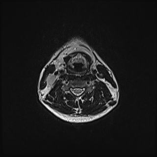 Nasopharyngeal carcinoma with perineural spread (Radiopaedia 55030-61380 Axial T2 58).jpg