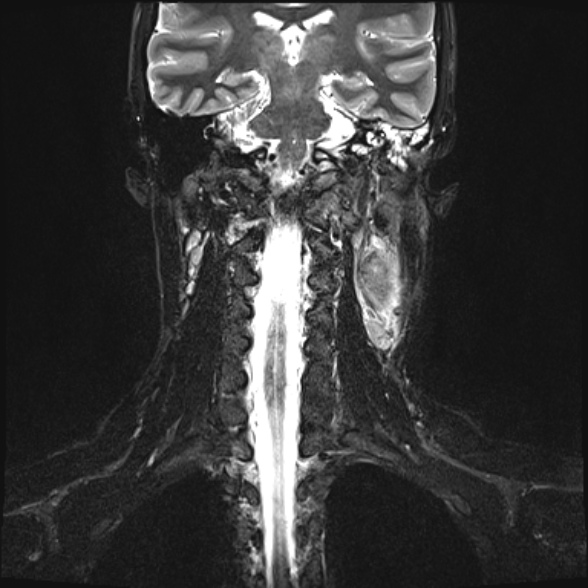 Nasopharyngeal carcinoma with skull base invasion (Radiopaedia 53415-59485 Coronal T2 fat sat 10).jpg