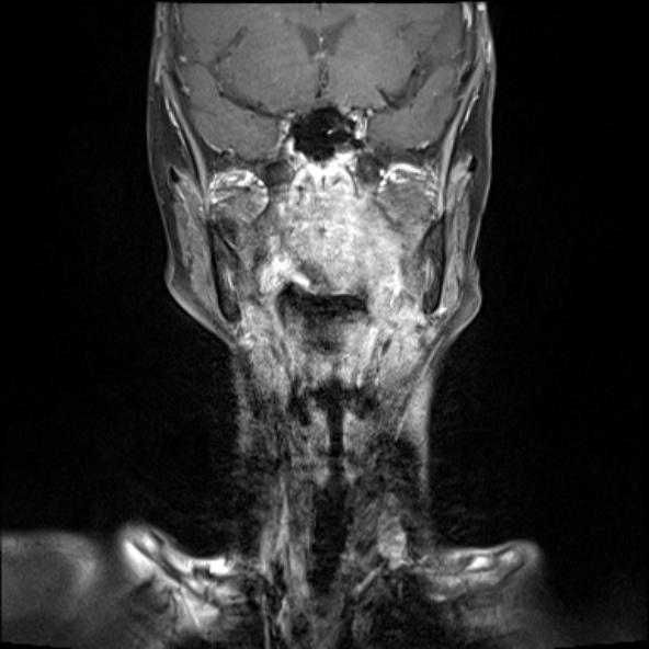 File:Nasopharyngeal non-Hodgkin lymphoma (Radiopaedia 30099-30686 Coronal T1 C+ 8).jpg