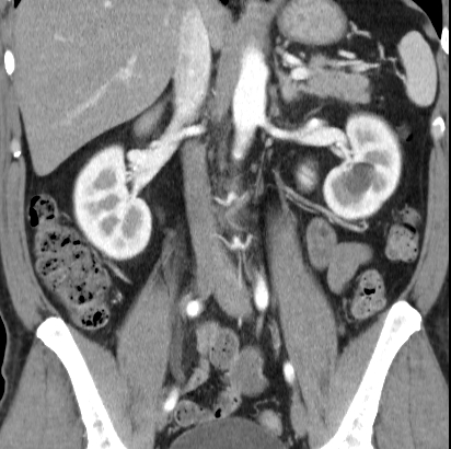 File:Necrotizing pancreatitis with acute necrotic collection (Radiopaedia 14470-14417 C 24).jpg