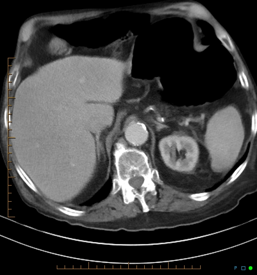 Necrotzing fasciitis due to a perforated adenocarcinoma of the splenic flexure (Radiopaedia 46930-51455 A 20).jpg