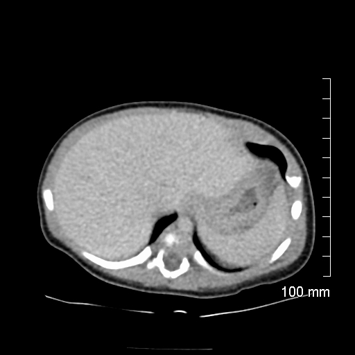 File:Neonatal neuroblastoma (Radiopaedia 56651-63438 Axial non-contrast 18).jpg