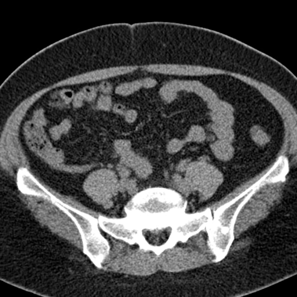 File:Nephrostomy for urosepsis (Radiopaedia 26180-26330 Axial non-contrast 44).jpg