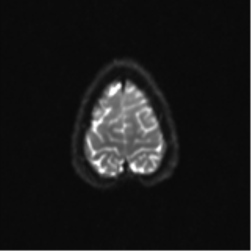 Neurenteric cyst (Radiopaedia 58641-65837 Axial DWI 32).png