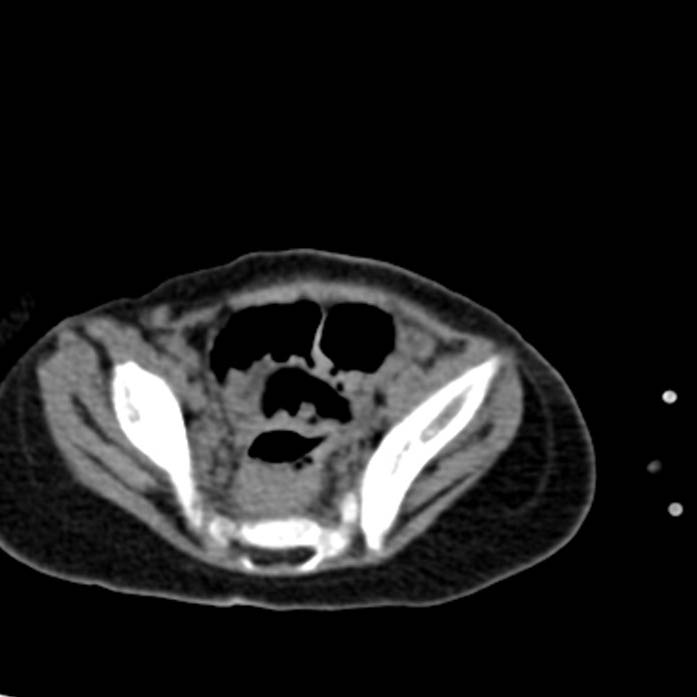 Neuroblastoma with skull metastases (Radiopaedia 30326-30960 Axial non-contrast 52).jpg