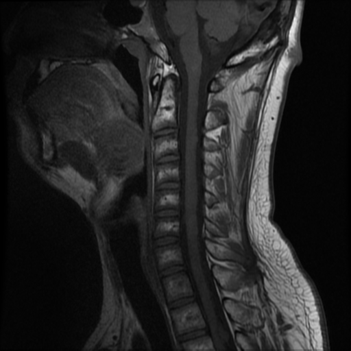 File:Neurofibromatosis type 2 (Radiopaedia 44936-48837 Sagittal T1 8).png