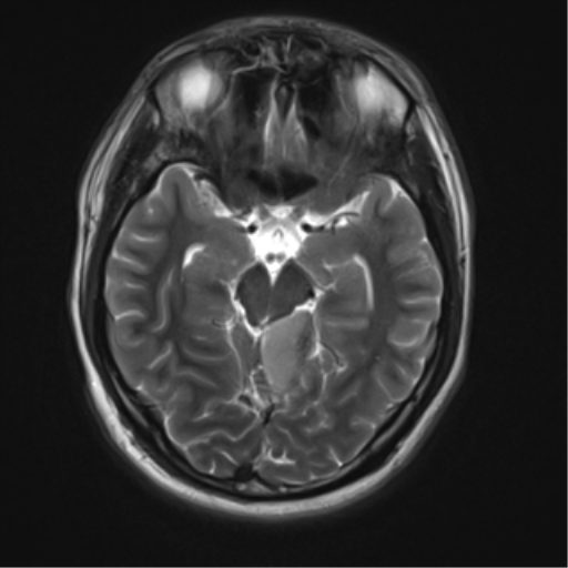 File:Neurofibromatosis type 2 (Radiopaedia 44936-48838 Axial T2 9).png