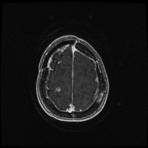 Neurofibromatosis type 2 (Radiopaedia 45229-49244 Axial T1 C+ 98).png