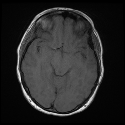 File:Neurofibromatosis type 2 (Radiopaedia 45229-49247 Axial T1 10).png