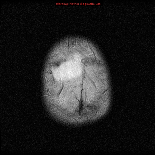 File:Neurofibromatosis type 2 (Radiopaedia 8953-9730 Axial FLAIR 24).jpg
