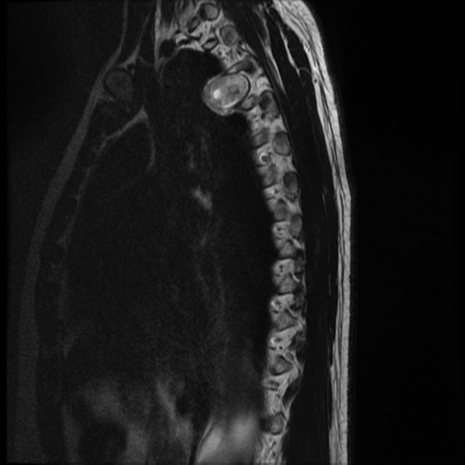 File:Neurofibromatosis type 2 (spinal manifestations) (Radiopaedia 53943-60070 C 14).png