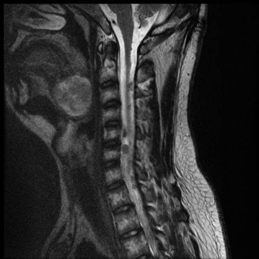 File:Neurofibromatosis type 2 (spinal manifestations) (Radiopaedia 53943-60070 Sagittal T2 5).png