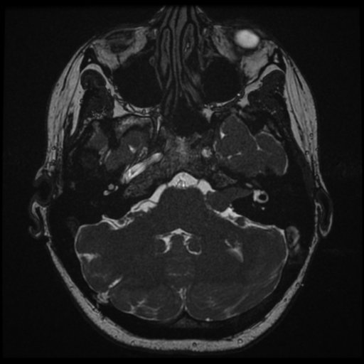 Neurofibromatosis type 2 - bilateral acoustic neuromata (Radiopaedia 40060-42566 Axial FIESTA 33).png
