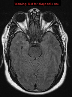 File:Neuroglial cyst (Radiopaedia 10713-11184 Axial FLAIR 15).jpg