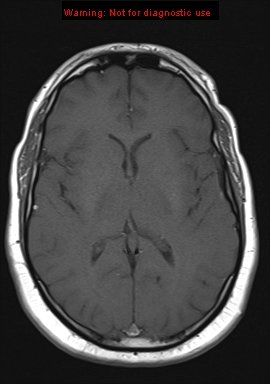 File:Neuroglial cyst (Radiopaedia 10713-11184 Axial T1 11).jpg