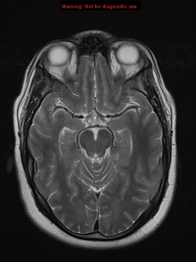File:Neuroglial cyst (Radiopaedia 10713-11184 Axial T2 14).jpg