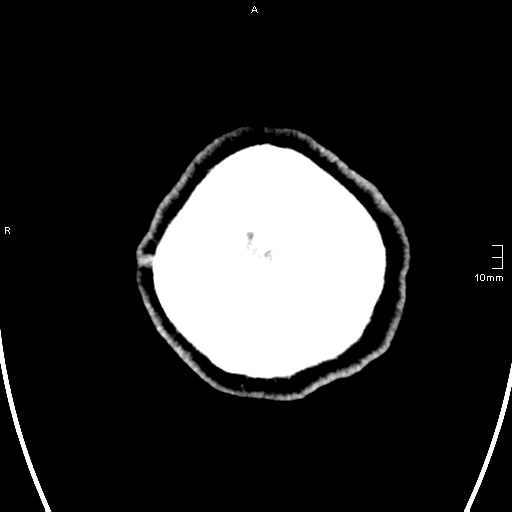 File:Neurotoxoplasmosis - concentric target sign (Radiopaedia 70644-80783 Axial non-contrast 41).jpg
