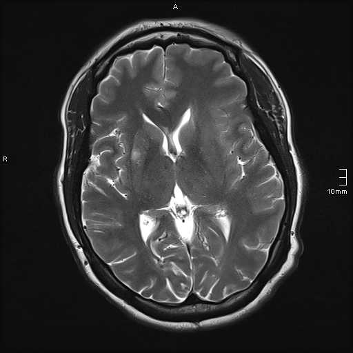 File:Neurotoxoplasmosis - concentric target sign (Radiopaedia 70644-80784 Axial T2 11).jpg