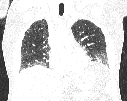 Non-specific interstitial pneumonia (NSIP) (Radiopaedia 68599-78228 Coronal lung window 40).jpg