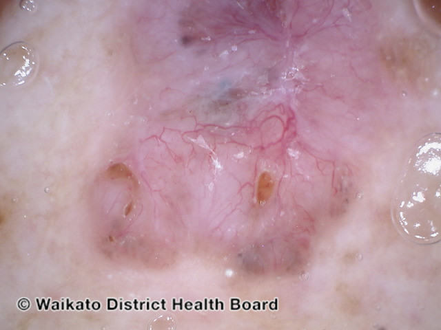 File:Nonpolarised dermoscopy of pigmented basal cell carcinoma (DermNet NZ nonpolarised-dermoscopy-bcc).jpg