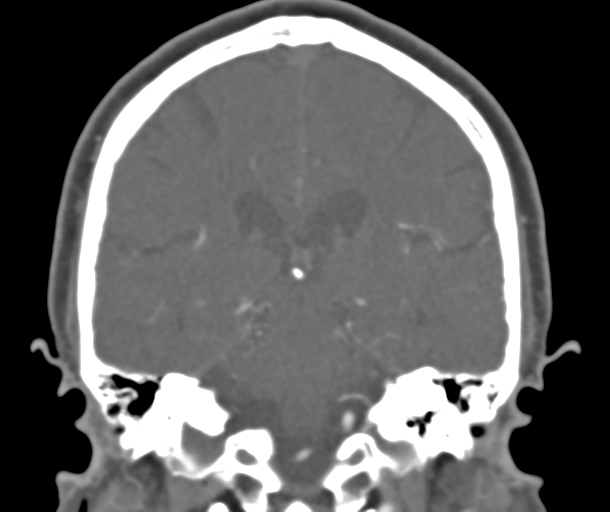 File:Normal CTA head (Radiopaedia 40801-43464 B 60).png