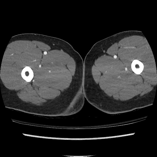 File:Normal CT angiogram of pelvis (Radiopaedia 45390-49430 A 74).jpg