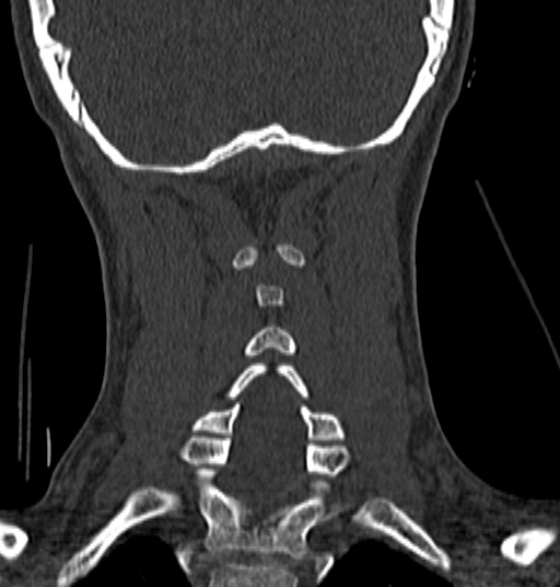 File:Normal CT cervical spine - 12-year-old (Radiopaedia 55352-61775 Coronal bone window 162).jpg