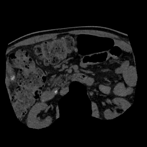 File:Normal CT intravenous cholangiogram (Radiopaedia 38199-40208 Axial IVC (MIP) 10).png