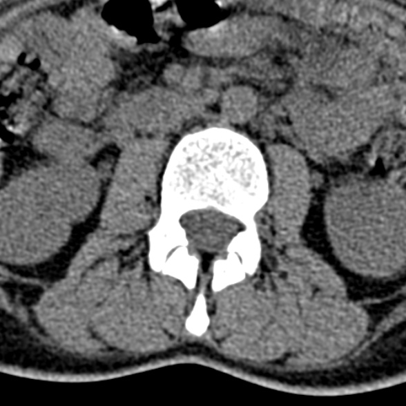 Normal CT lumbar spine (Radiopaedia 53981-60118 Axial non-contrast 43).jpg
