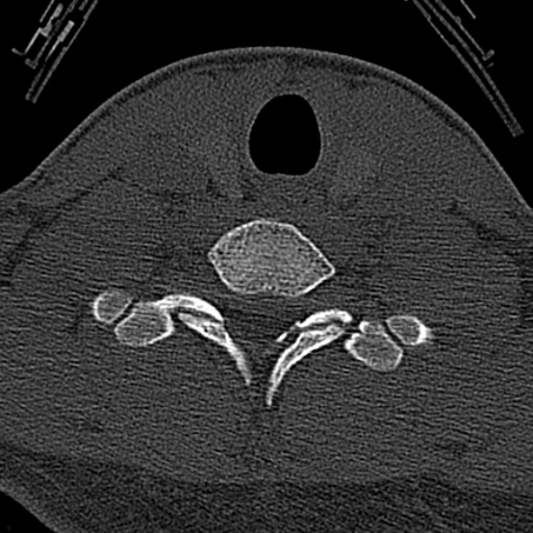 File:Normal CT of the cervical spine (Radiopaedia 53322-59305 Axial bone window 215).jpg