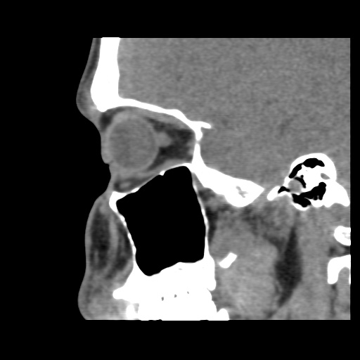 Normal CT paranasal sinuses (Radiopaedia 42286-45390 F 51).jpg