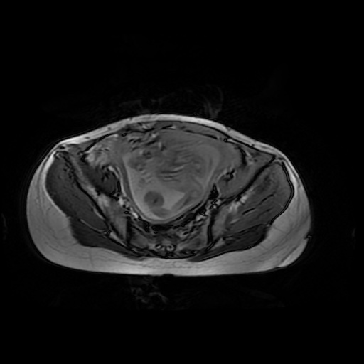 File:Normal MRI abdomen in pregnancy (Radiopaedia 88001-104541 Axial Gradient Echo 44).jpg