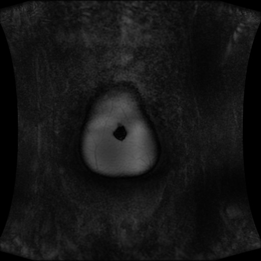 Normal MRI abdomen in pregnancy (Radiopaedia 88001-104541 N 11).jpg