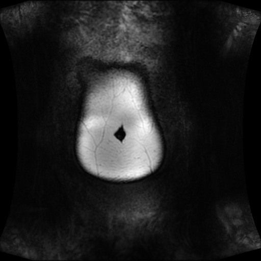 Normal MRI abdomen in pregnancy (Radiopaedia 88001-104541 N 14).jpg