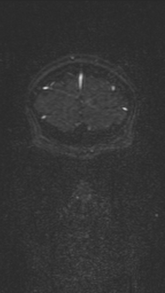 Normal MRI brain with MRV- teenager (Radiopaedia 49425-54553 Coronal MRV 43).jpg