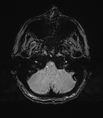 Normal brain MRI (TLE protocol) (Radiopaedia 40748-43405 Axial SWI 12).png