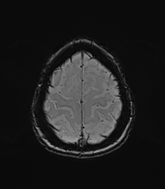 Normal brain MRI (TLE protocol) (Radiopaedia 40748-43405 Axial SWI 76).png