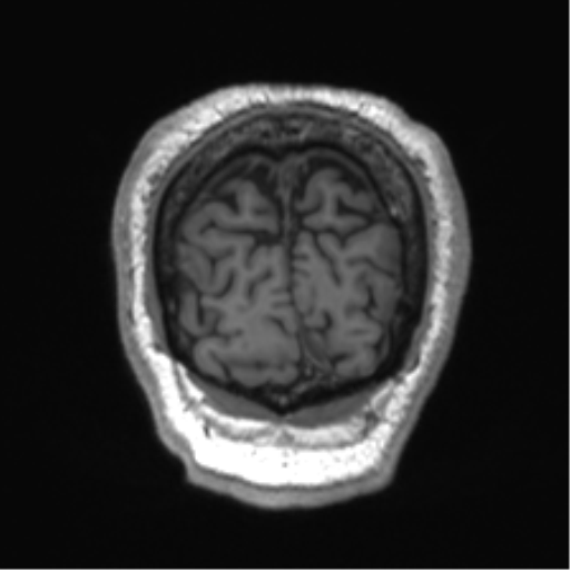 Normal brain MRI (non-focal epilepsy protocol) (Radiopaedia 53917-60040 Coronal T1 9).png