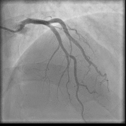 Normal coronary angiogram (DSA) (Radiopaedia 63081-71571 E 35).jpg
